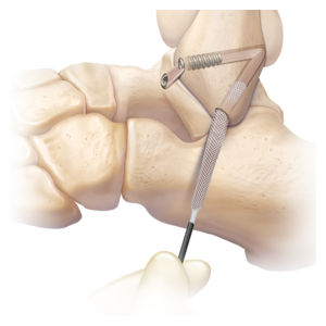 أربطة الكاحل