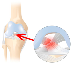 الرباط الصليبي