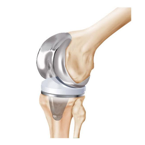 تغيير مفصل الركبة