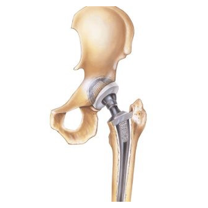 تغيير مفصل الفخذ