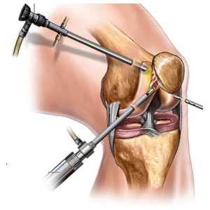 منظار الركبة
